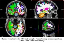 Regions from a brain in the ADNI study using the Freesurfer image processing software